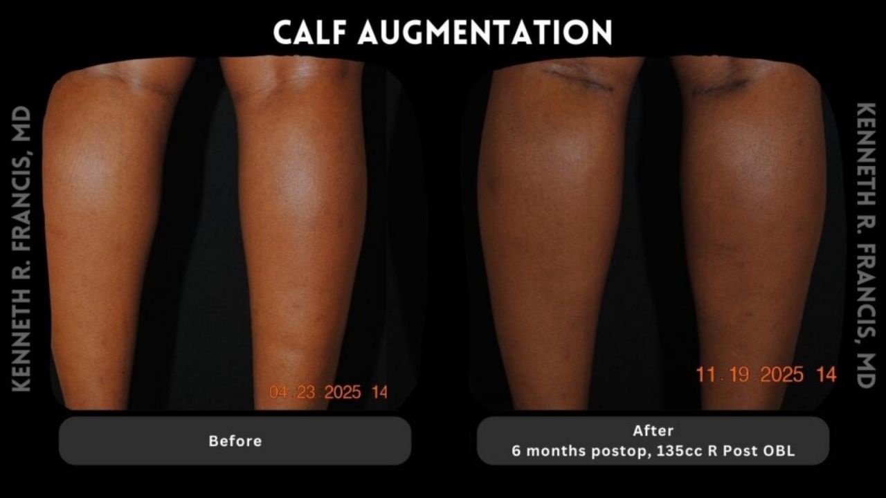 Side-by-side comparison of legs showing "before" and "after" results of calf augmentation, taken 6 months apart, with visible increase in calf size post-operation.