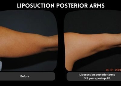 Side-by-side comparison of an arm before and 3.5 years after liposuction, showing reduced fat in the posterior arm.