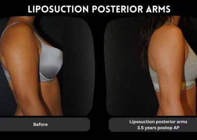 Side-by-side comparison of a woman's arm before and 3.5 years after liposuction, showing a slimmer appearance in the postoperative photo.