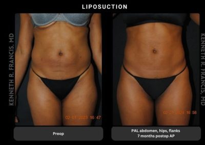 Side-by-side images of a woman's torso before and seven months after liposuction on the abdomen, hips, and flanks, showing a slimmer post-procedure appearance.