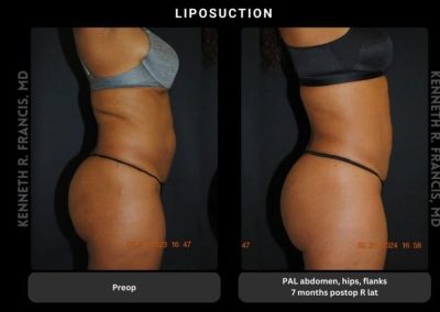 Side-by-side photos showing a woman's body before (left) and seven months after (right) abdominal, hip, and flank liposuction. Noticeable reduction in body contour is visible post-surgery.