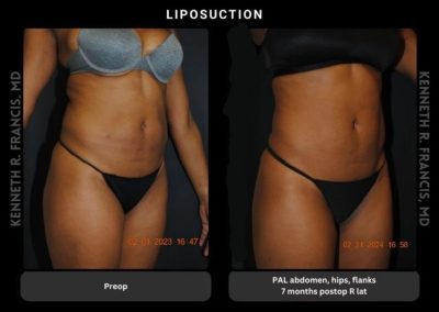 Side-by-side images showing a woman's torso before (left) and 7 months after (right) liposuction to the abdomen, hips, and flanks. The post-op image shows a slimmer contour.