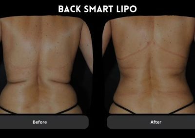 Side-by-side comparison of a person's back labeled "Before" and "After" Smart Lipo, showing reduced fat and a more contoured appearance in the "After" image.
