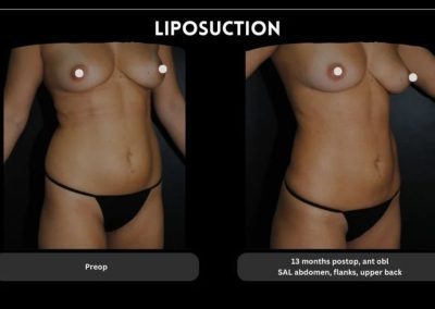 Before and after photos of a woman’s torso showing results of liposuction, with the left labeled “Preop” and the right labeled “13 months postop” on abdomen, flanks, and upper back.
