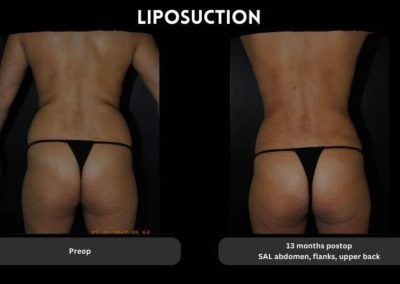 Side-by-side photos of a person's lower back and buttocks before and 13 months after liposuction, showing changes in body contour.