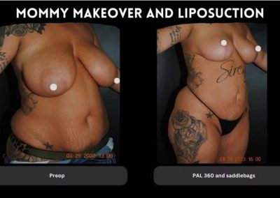 Side-by-side photos showing a woman before and after a mommy makeover and liposuction, highlighting body contour changes and visible tattoos.