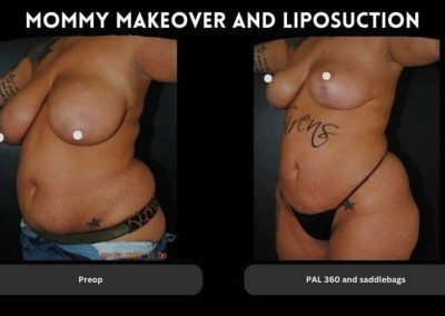 Side-by-side comparison of a woman’s torso before and after a mommy makeover and liposuction, showing reduced abdominal fat and reshaped contours in the after photo.