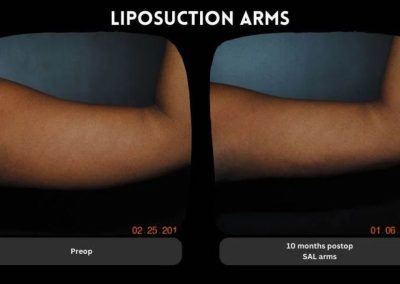 Side-by-side images show an arm before (left) and 10 months after (right) liposuction, with visible reduction in arm size. Labels indicate "Preop" and "10 months postop SAL arms".