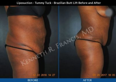 Side-by-side photos show a woman's torso before and after liposuction, tummy tuck, and Brazilian butt lift procedures. The "after" image shows a flatter abdomen and more contoured profile.