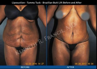 Side-by-side photos showing a woman's torso before and after liposuction, tummy tuck, and Brazilian butt lift procedures.