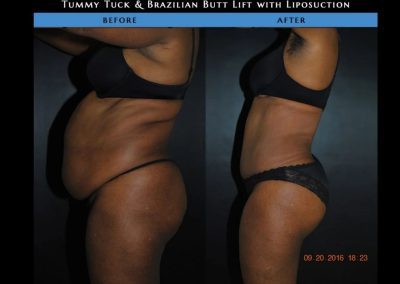Side-by-side comparison of a woman before and after tummy tuck and Brazilian butt lift with liposuction, showing a slimmer abdomen and enhanced buttocks in the after image.