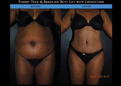 A side-by-side comparison shows a woman before and after tummy tuck and Brazilian butt lift with liposuction, highlighting changes in her abdomen and waist.