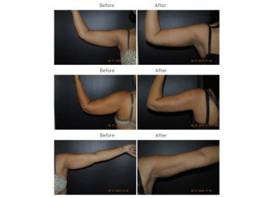 Side-by-side before and after photos showing a person's upper arm from multiple angles, illustrating a visible reduction in arm size or contour.