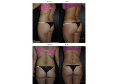 Side-by-side before and after photos of a woman in lingerie, showing physical changes to her lower back and buttocks from two different angles.