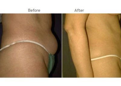 Side-by-side comparison showing a torso before and after a body contouring procedure, with reduced abdominal bulge in the "after" image.