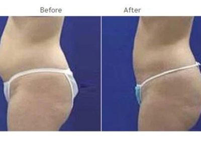 Side-by-side photos of a person’s midsection showing a larger abdomen in the "Before" image and a slimmer abdomen in the "After" image.