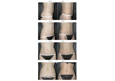 Side-by-side before and after photos show a person's midsection and lower back, highlighting visible changes in body contour over time.