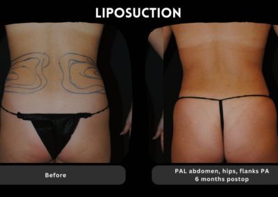 Before and after photos of a person’s lower back and hips, showing marked areas pre-liposuction and results six months after the procedure.