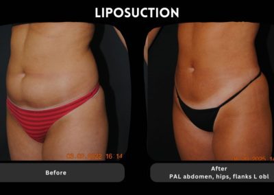Side-by-side photos of a woman’s lower torso before and after liposuction, showing reduced abdominal and hip fat in the "after" image.