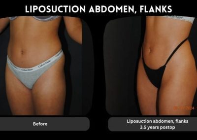 Side-by-side photos show a woman's abdomen and flanks before and 3.5 years after liposuction, with visible slimming in the postoperative image.