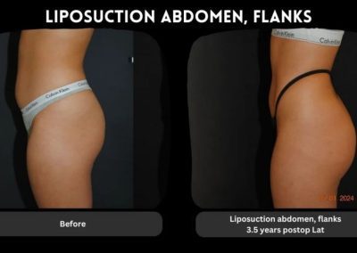Side view of a person’s abdomen and flanks before and 3.5 years after liposuction, showing a reduction in body fat and a more contoured profile.