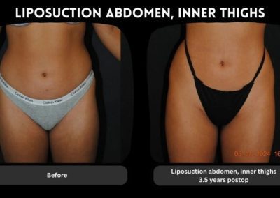 Before and after photos of a woman’s lower torso showing results of liposuction on the abdomen and inner thighs, taken 3.5 years apart.