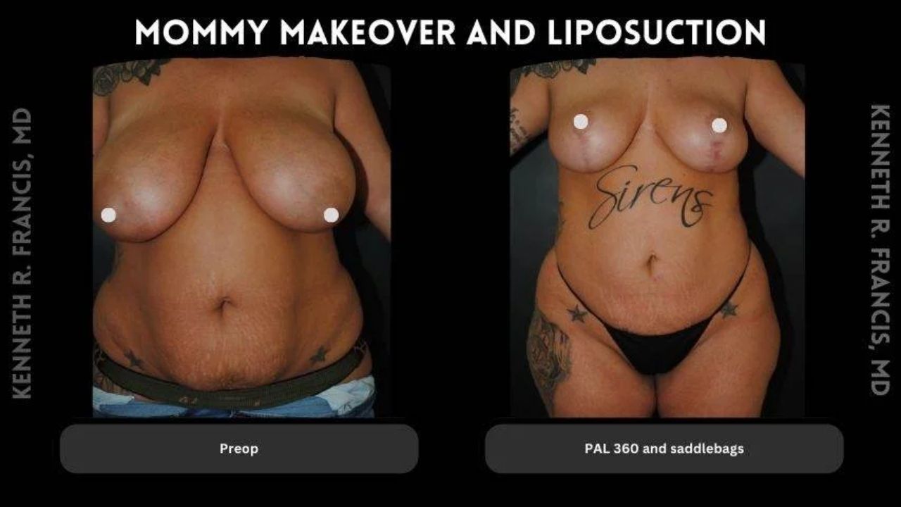 Before and after photos of a woman’s torso showing results of a mommy makeover and liposuction, with noticeable changes in contour and shape.
