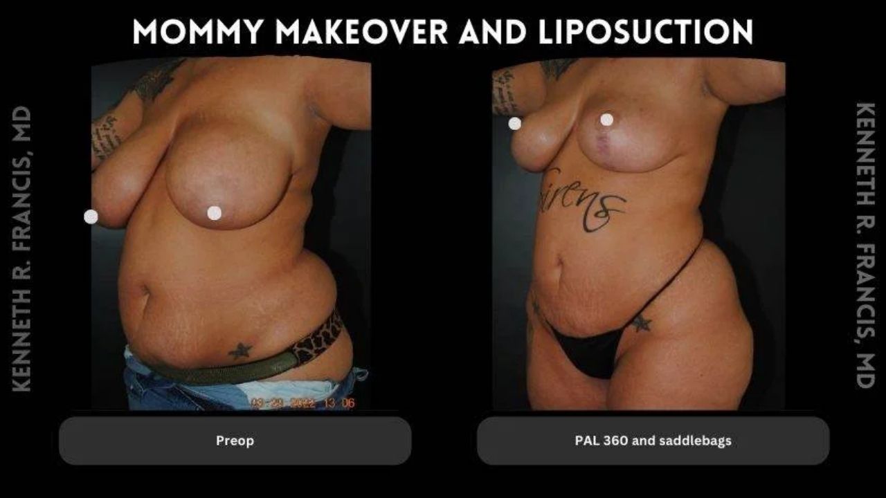 Before and after photos of a woman showing results of a mommy makeover and liposuction, with visible reductions in abdominal and hip areas.