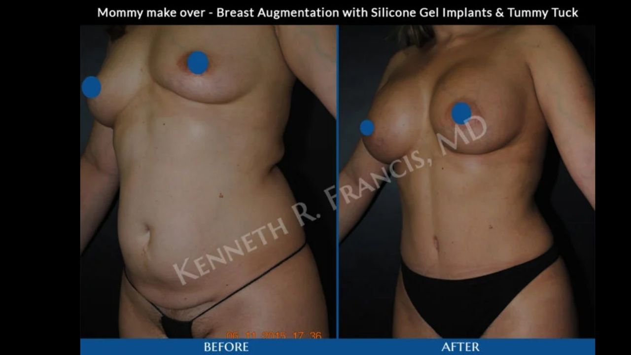 Before-and-after photos of a woman showing results of breast augmentation with silicone gel implants and a tummy tuck. Blue dots cover the nipples for privacy.