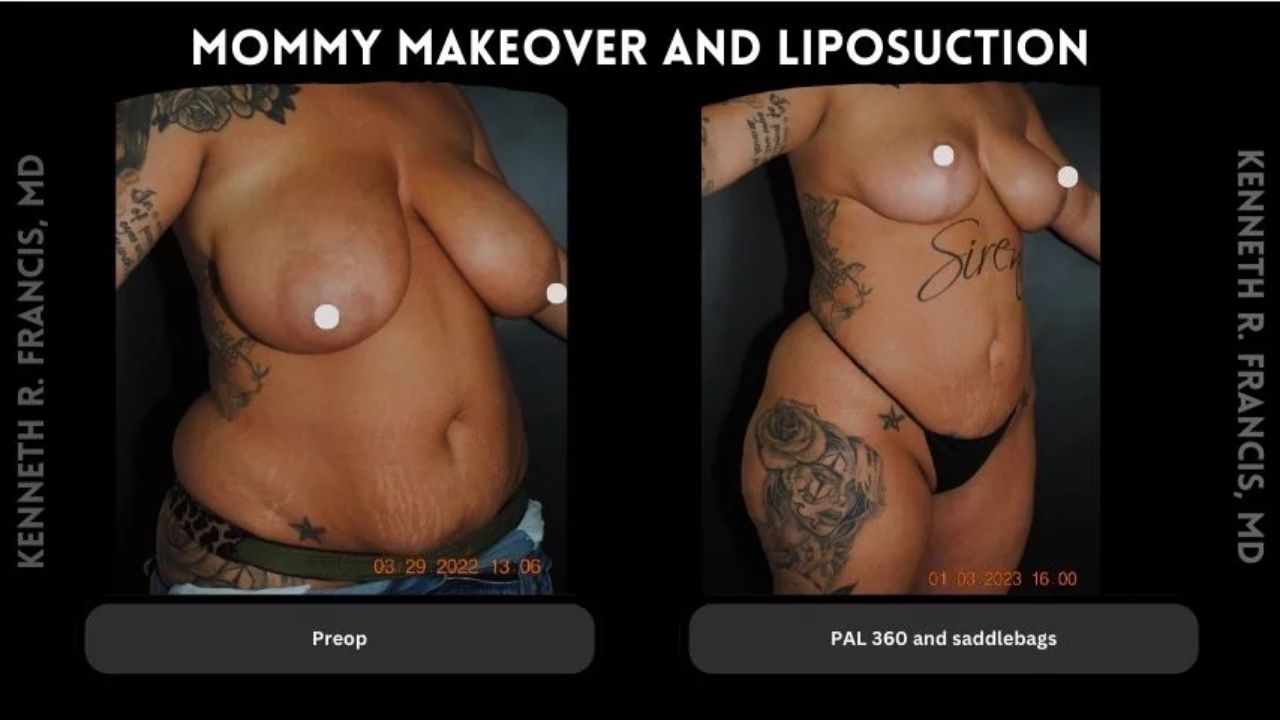 Side-by-side photos show a woman before and after a mommy makeover and liposuction procedure, highlighting reduced abdominal fat and body contouring results.