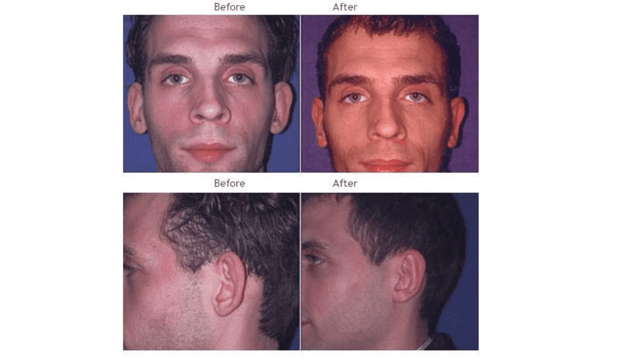 Before and after photos of a man’s face from the front and side, showing changes in ear prominence.