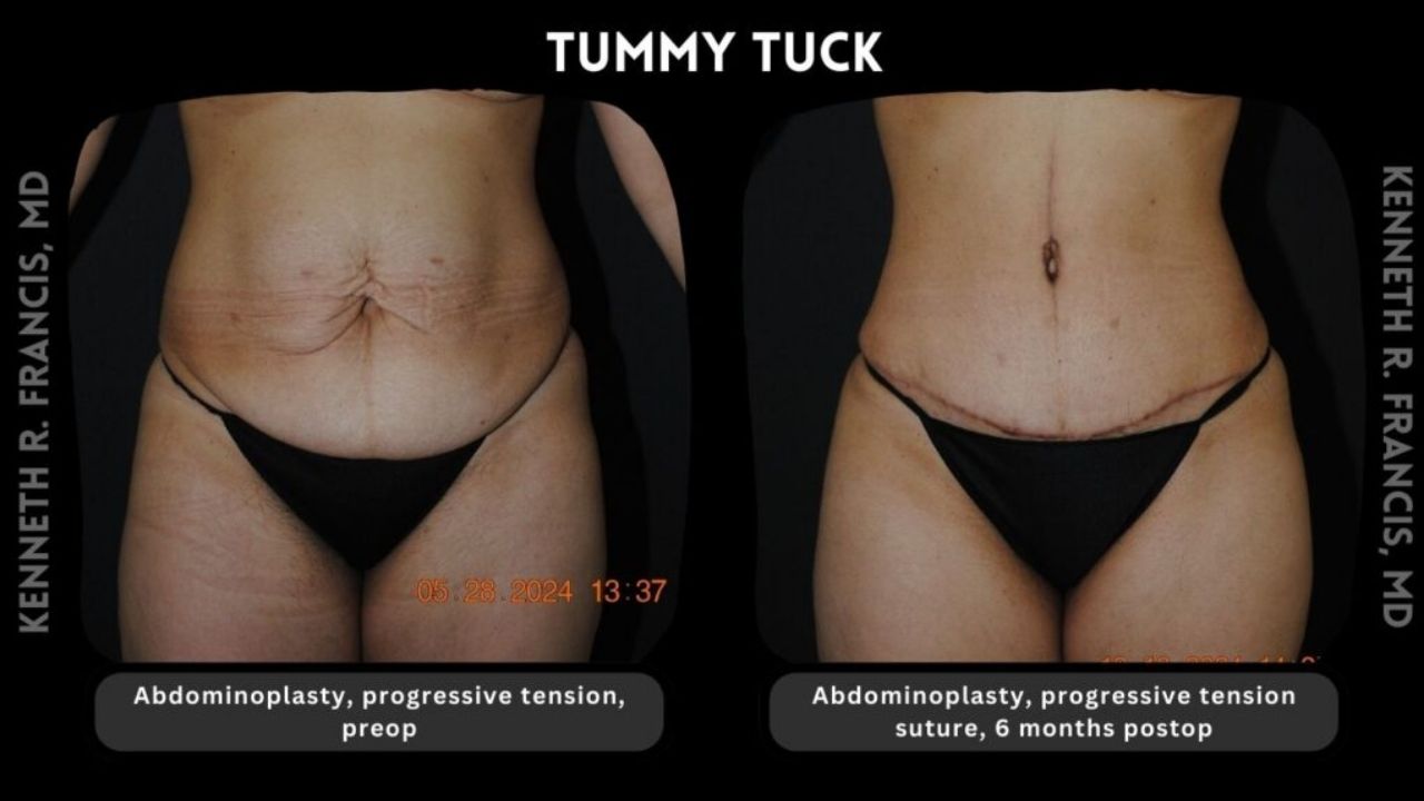 Kenneth Francis Before and Afters -Tummy Tuck (1)