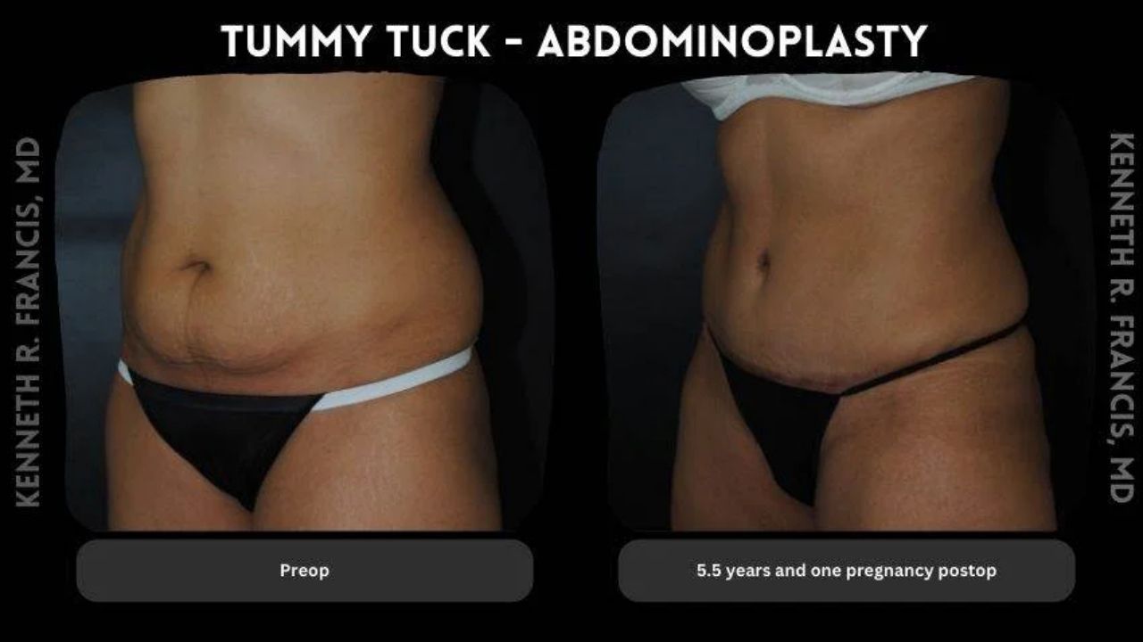 Side-by-side comparison of a woman's abdomen before and after a tummy tuck, showing reduced loose skin and a flatter appearance in the postop image.