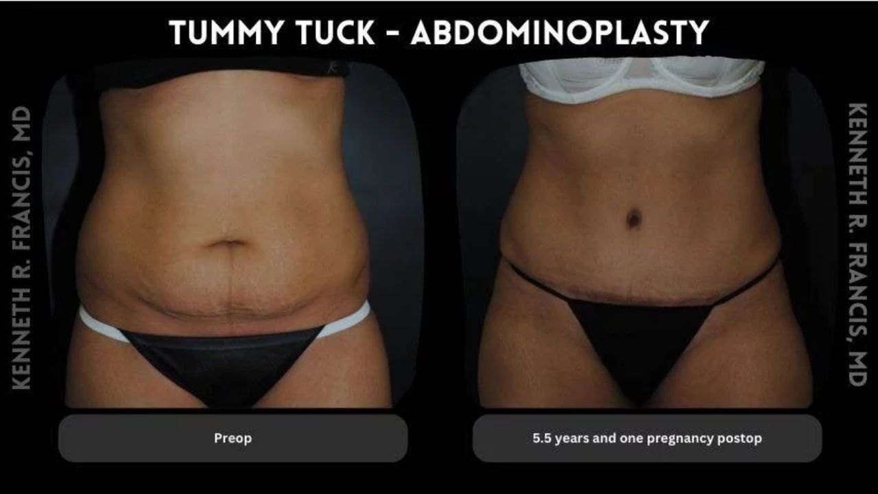 Side-by-side comparison of a woman's abdomen before (left) and 5.5 years after (right) a tummy tuck, showing reduced loose skin and a flatter appearance.