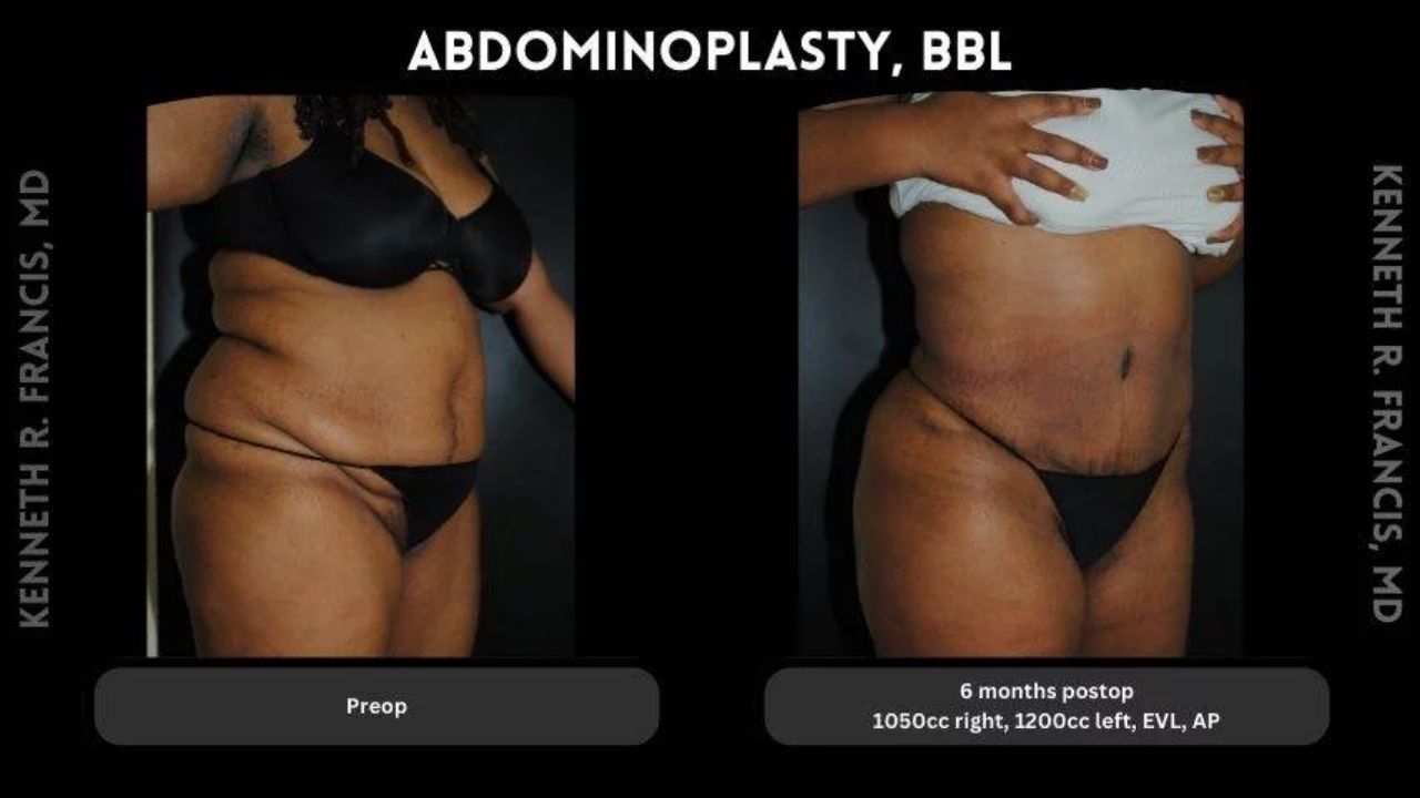 Side-by-side photos showing a woman before and 6 months after abdominoplasty and BBL surgery, with noticeable reduction in abdominal fat and body contour changes.