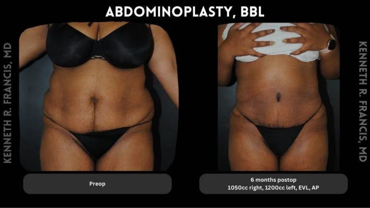 Two side-by-side images show a person’s abdomen before (left) and six months after (right) abdominoplasty and BBL surgery, demonstrating a slimmer, more contoured appearance postoperatively.