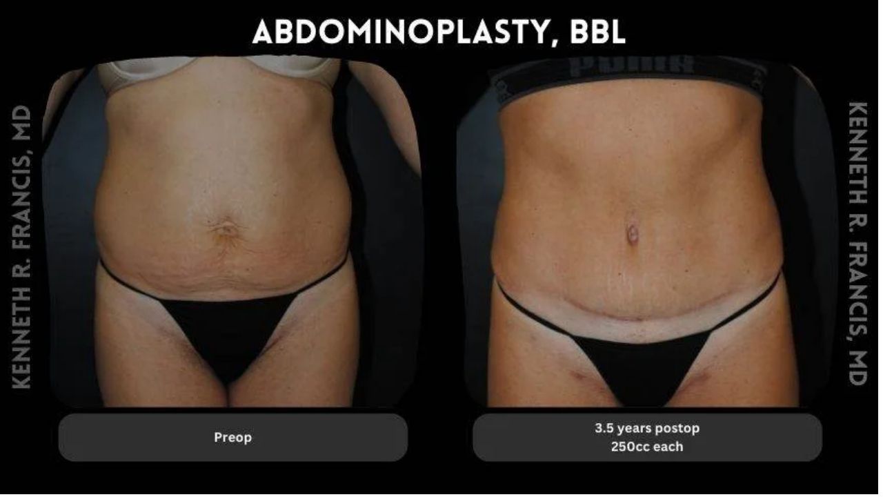Side-by-side photos show a woman’s abdomen before and 3.5 years after abdominoplasty and BBL, highlighting reduced loose skin and visible surgical scar post-operation.
