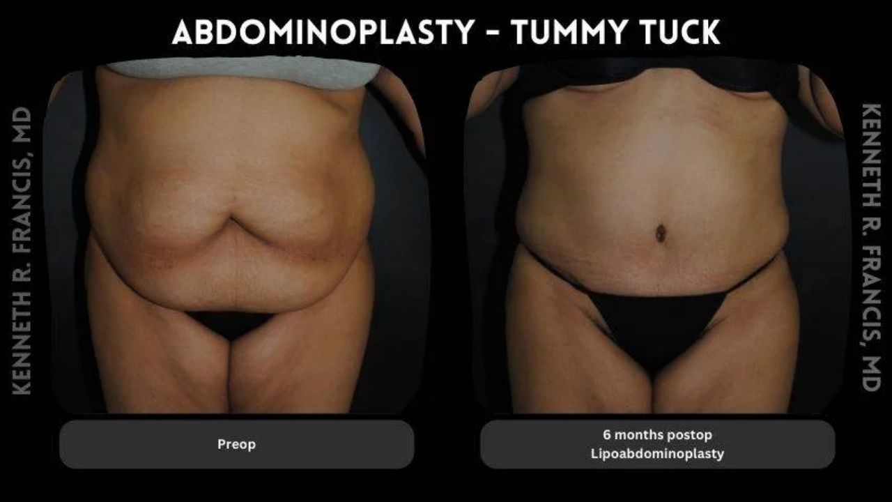 Side-by-side photos of a person’s abdomen before (left) and six months after (right) abdominoplasty, showing reduced skin and fat in the postoperative image.