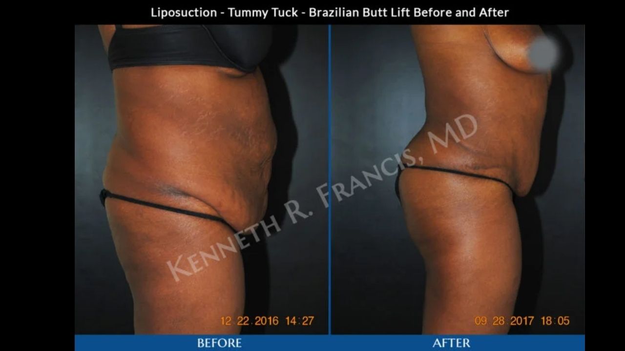 Side-by-side before and after photos of a woman's torso showing reduced abdominal fat and tighter skin following liposuction, tummy tuck, and Brazilian butt lift procedures.