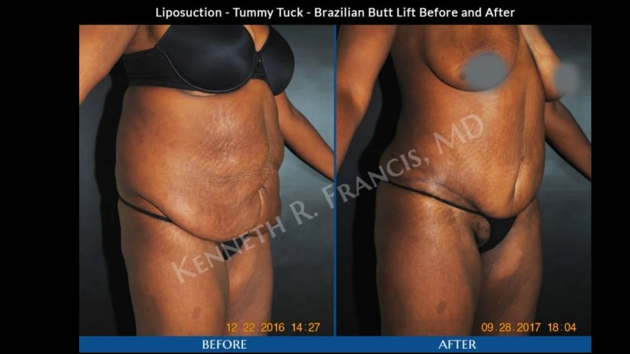Side-by-side photos showing a woman before and after liposuction, tummy tuck, and Brazilian butt lift procedures. The "before" image shows loose abdominal skin; the "after" image shows a flatter abdomen.