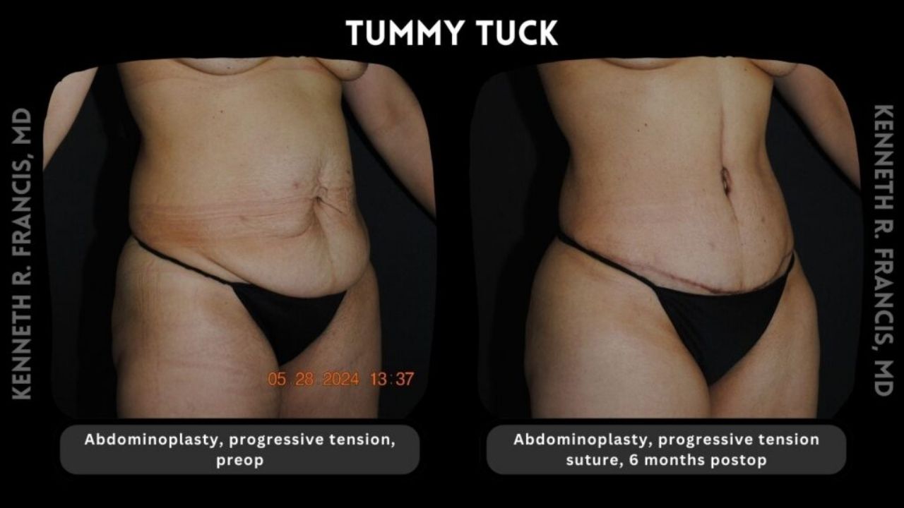 Side-by-side photos show a torso before and after a tummy tuck procedure, displaying reduced abdominal sagging and a surgical scar at six months post-operation.