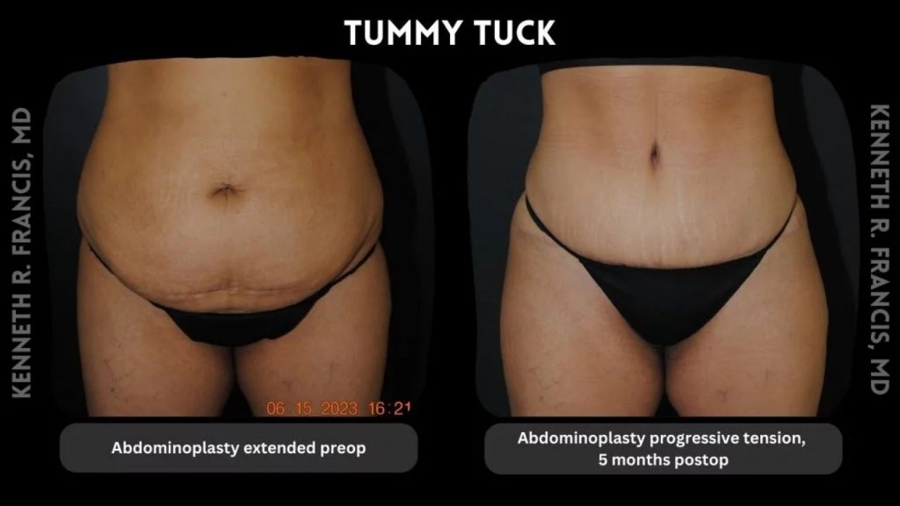 Side-by-side comparison of a woman's abdomen before and five months after a tummy tuck, showing reduced loose skin and improved contour.