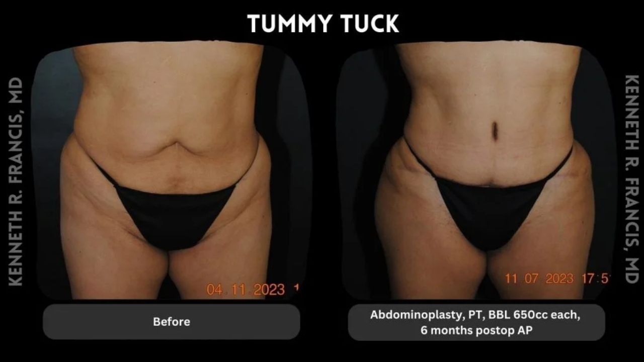 Side-by-side photos of a woman before and six months after tummy tuck surgery, showing reduced abdominal skin and improved contour.
