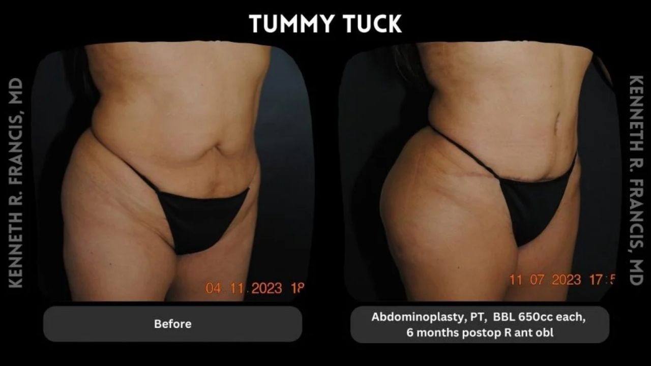 Side-by-side comparison of a person's abdomen before and after a tummy tuck, showing reduced skin laxity and contour improvement 6 months post-surgery.