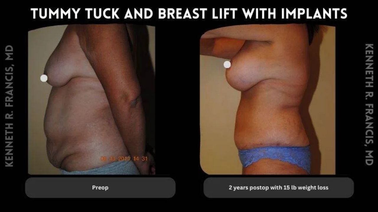 Side-by-side photos show a woman before and after tummy tuck and breast lift with implants, with visible weight loss after two years post-operation.