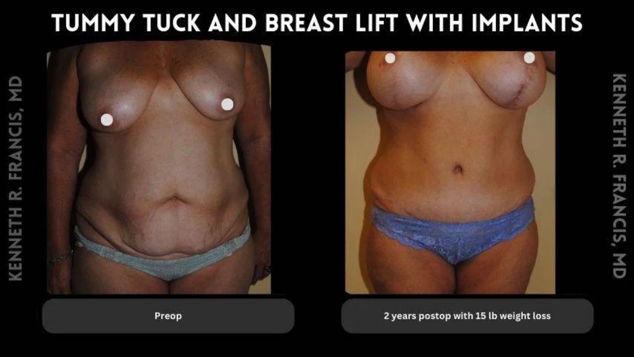 Before and after photos of a woman showing results of a tummy tuck and breast lift with implants, including noticeable weight loss over two years.