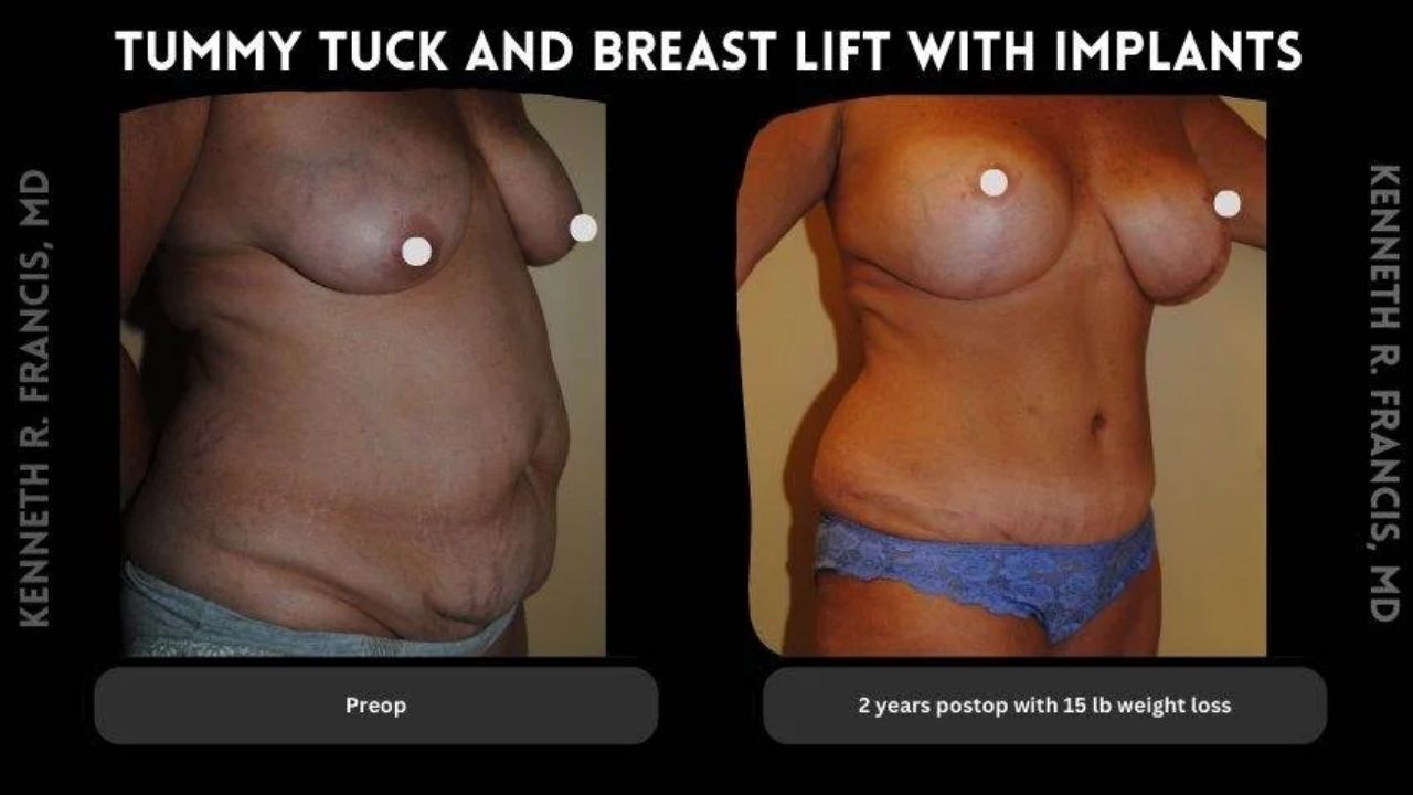 Side-by-side photos show a person before and after tummy tuck and breast lift with implants; left is pre-operation, right is 2 years post-operation with 15 lb weight loss.
