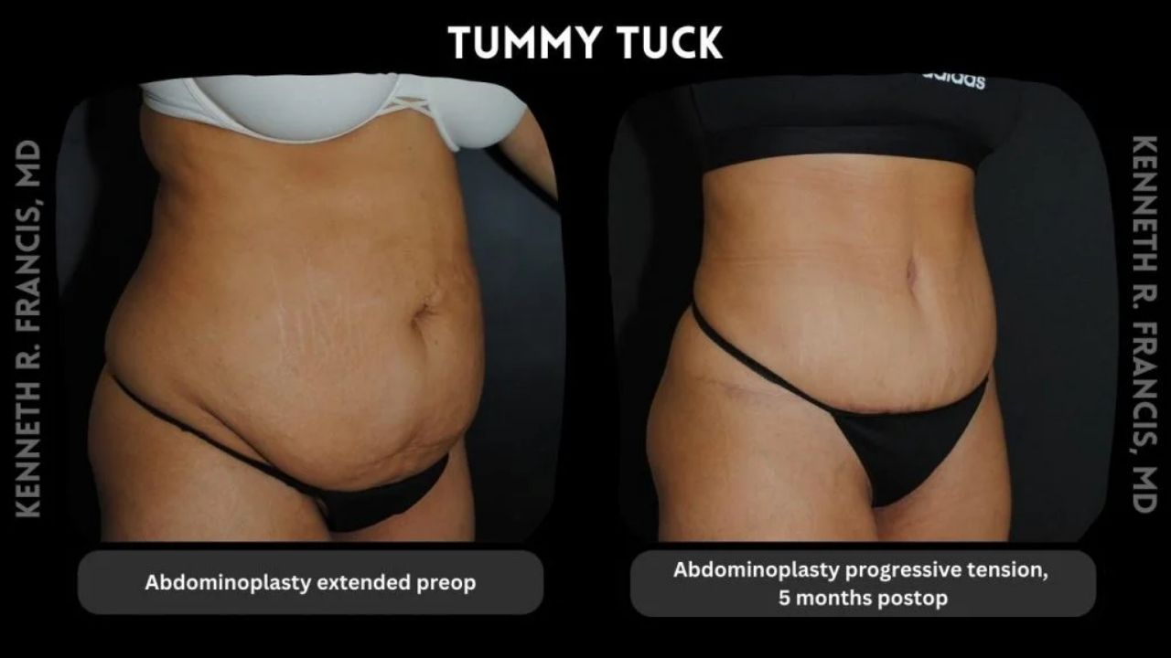 Kenneth Francis Before and Afters -Tummy Tuck