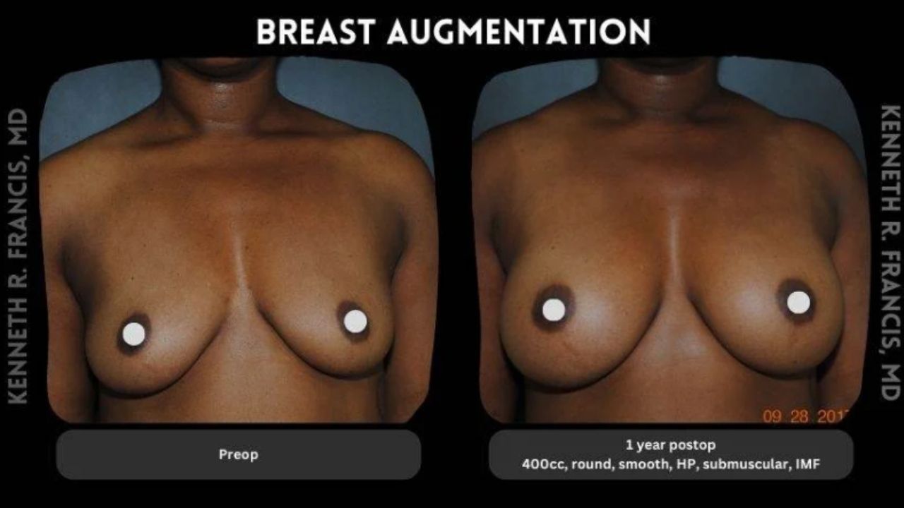 Side-by-side comparison of a woman’s chest before and after breast augmentation; left shows preoperative state, right shows results one year post-surgery with implants.