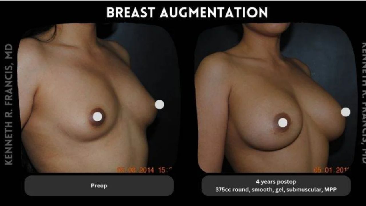 Side-by-side comparison of a woman's chest before and four years after breast augmentation surgery, showing increased breast size and roundness post-operation.